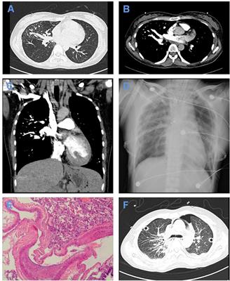 Bilateral Lung Transplantation for Congenital Pulmonary Arteriovenous Fistula with Intraoperative Venovenous ECMO Support: The First Case Report in China